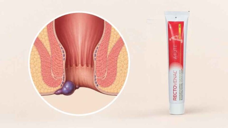 Medicinska ilustracija spoljašnjeg hemoroida pored Rectovenal Acute preparata za tretman hemoroida